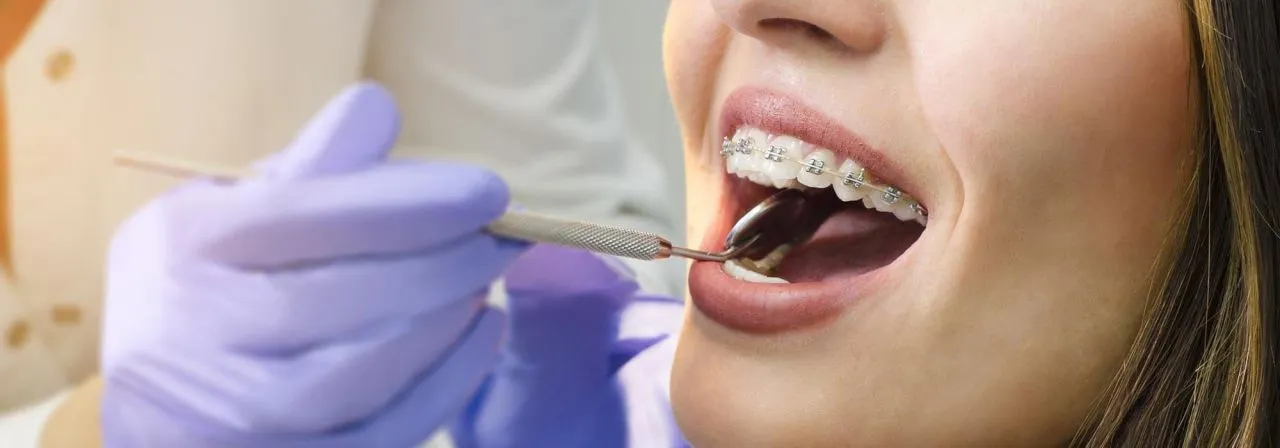 Aparat dentar mobil