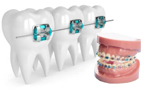 Aparat dentar pentru adulti