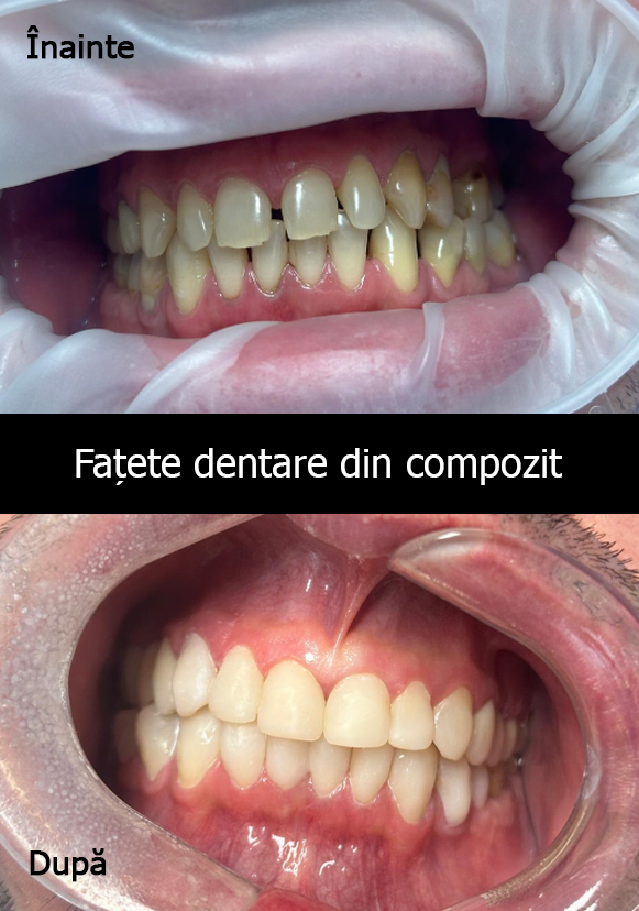 Fațete Dentare din Compozit