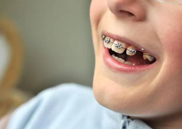 Aparat dentar mobil