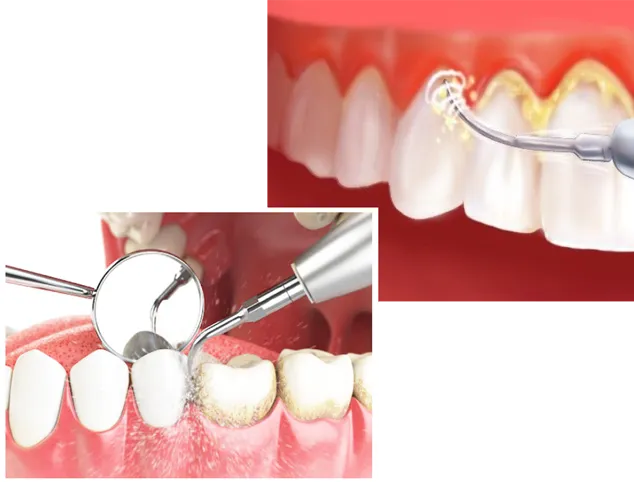 Detartraj și igienizare dentară
