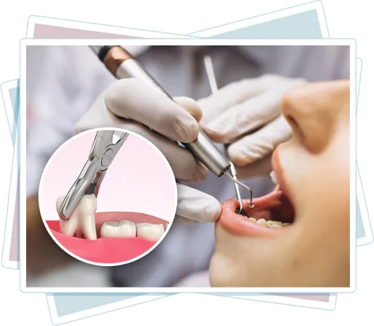 Extracția dentară Magnum Dent Bragadiru