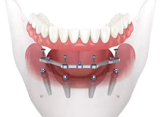 Dinți ficși pe 4 implanturi dentare