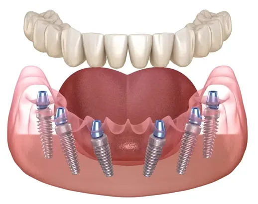 Dinți ficși pe 6 implanturi dentare