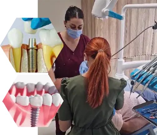Inserare iomplant dentar