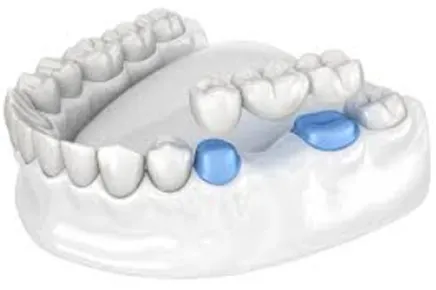 Puntea dentară